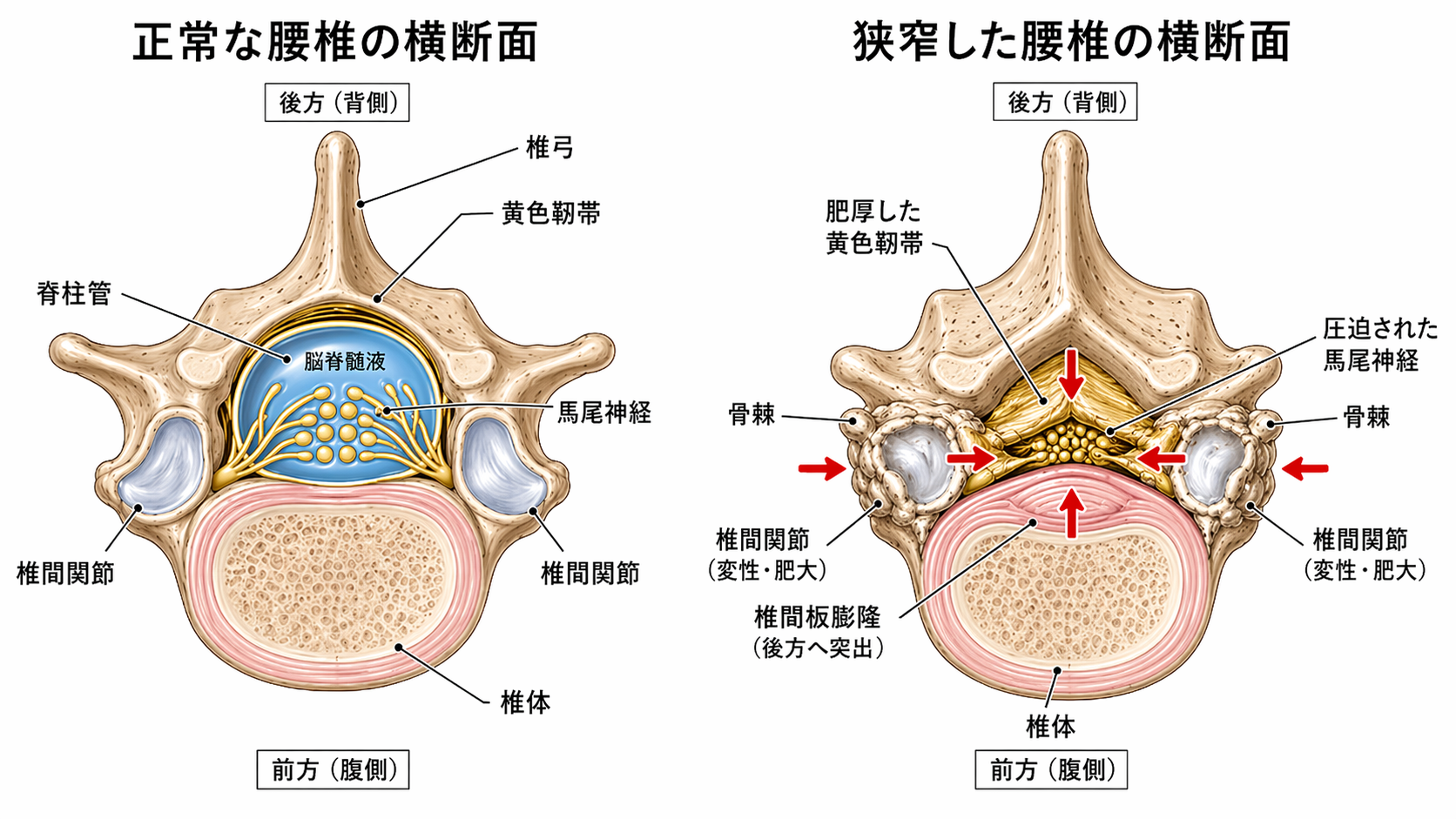 正常な腰椎の横断面と狭窄した腰椎の横断面の比較イラスト
